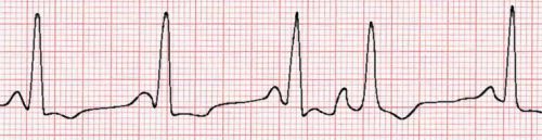 atrial extrasystole