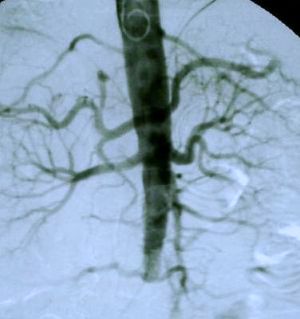 Aortic angiogram of patient showing iliac arteries tapering off to nothing