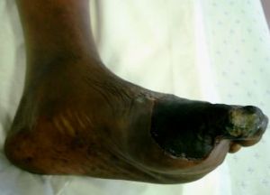 gangrene of foot