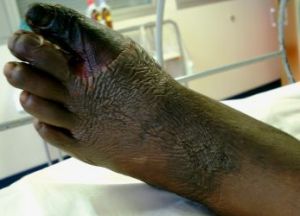 gangrene showing black toes