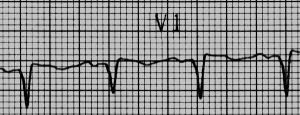 ECG taken after 11 days showing well-established Q waves with settling of ST segment
