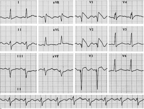 ECG picture - is this a RBBB? Wide bizarre R prime waves in V1 and adjacent leads