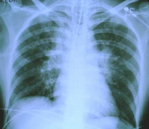 initial chest x-ray