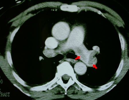 Spiral CT of pulmonary artery showing thrombus in 
left pulmonary artery