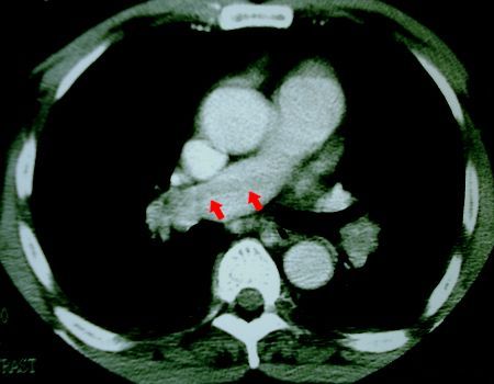 CT of pulmonary artery showing large thrombus extending into right 
pulmonary artery