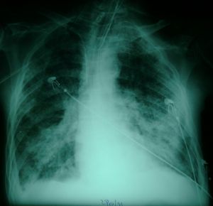 Chest x-ray before recruitment maneuver