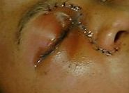 postoperative image of the patient showing marked inflammatory reaction near the eye