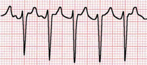 atrial flutter with 2:1 block