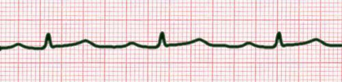 prolonged PR interval: first degree heart block