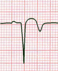 Q wave, with ST elevation and inverted T, in acute MI