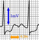 ECG voltage and timing