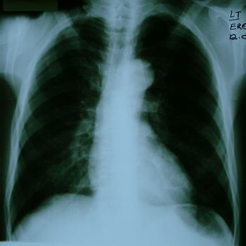 Chest x-ray of patient showing a normal-sized heart, really rather unremarkable but is there pulmonary oedema?