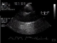 CLICK FOR VIDEO: Ascending aorta lax view