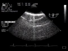 CLICK FOR VIDEO: descending aorta lax view