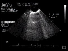 CLICK FOR VIDEO: descending aorta SAX view