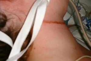 linear skin abrasion following attempted hanging