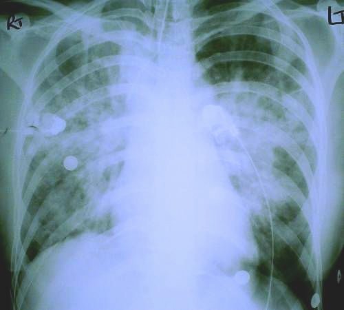 subsequent chest x-ray